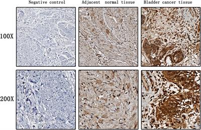 Serum EZH2 is a novel biomarker for bladder cancer diagnosis and prognosis